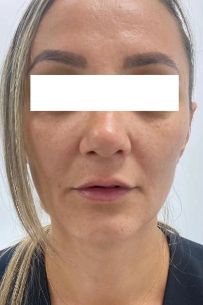 Antes — Aumento de labios 1 - Antes