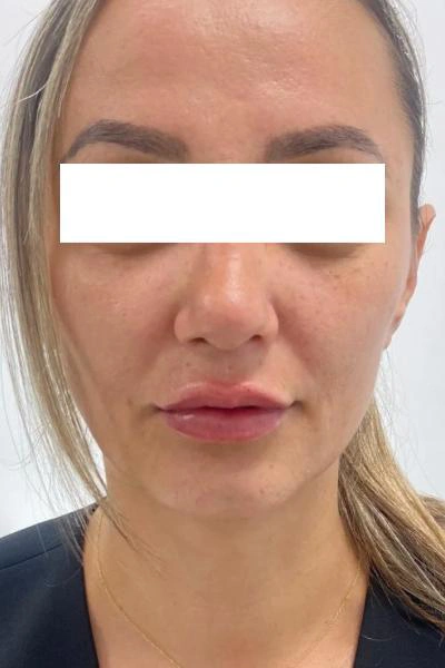 Después — Aumento de labios 1 - Antes