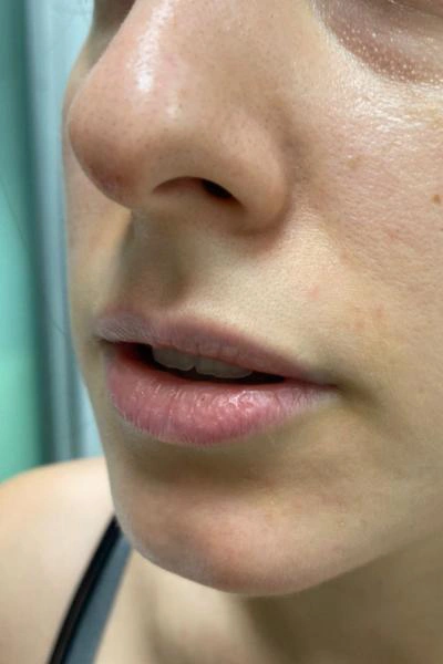 Antes — Aumento de labios 2 - Antes