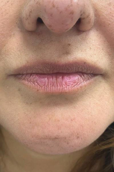 Antes — Aumento de labios 4 - Antes