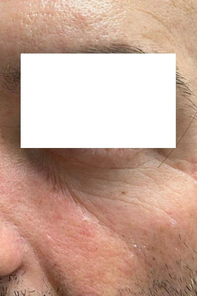 Before — Eliminacion de ojeras 1 - Antes