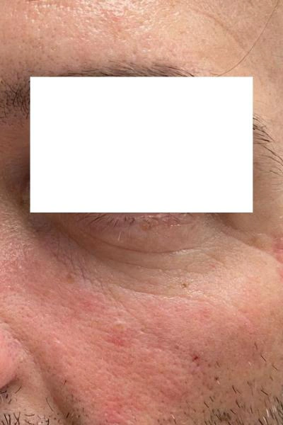 After — Eliminacion de ojeras 1 - Antes