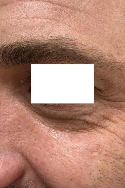 Before — Eliminacion de ojeras 2 - Antes