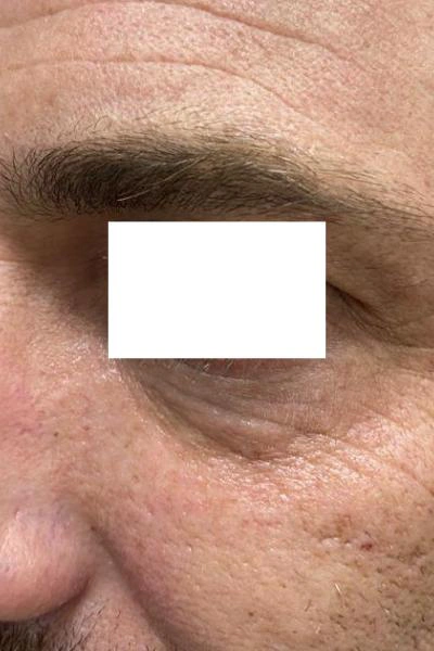 After — Eliminacion de ojeras 2 - Antes
