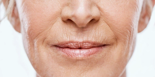 Lines Around the Mouth