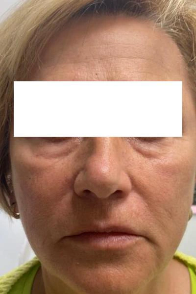 Before — Eliminacion de ojeras 1 - Antes