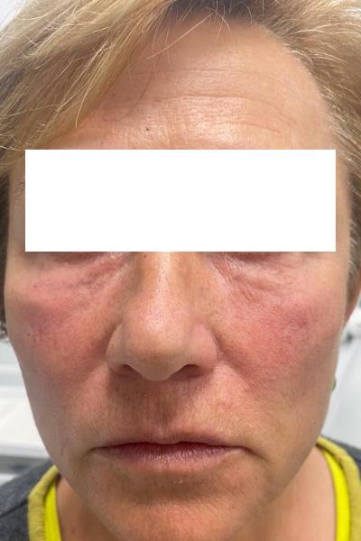 After — Eliminacion de ojeras 1 - Antes