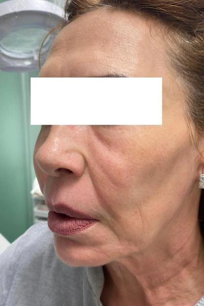 Before — Flacidez facial 3 - Antes