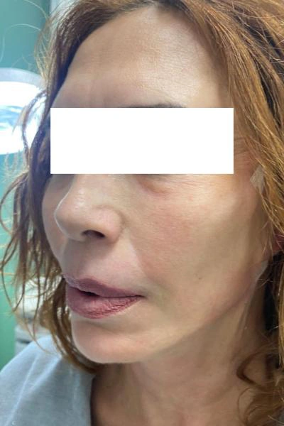 After — Flacidez facial 3 - Antes