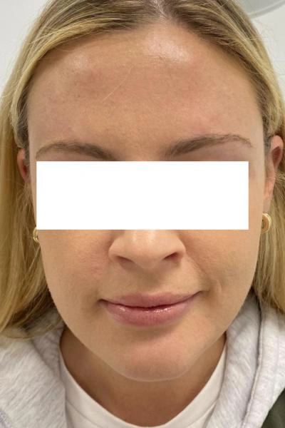 After — Neuromoduladores 1 - Antes