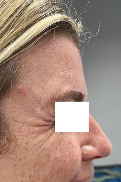 Before — Neuromoduladores 10 - Antes