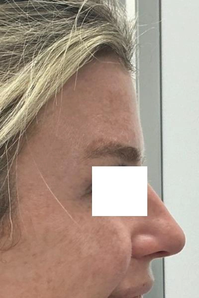 After — Neuromoduladores 10 - Antes