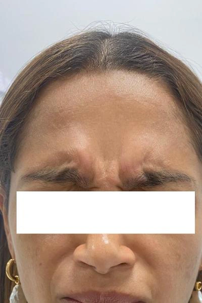 Before — Neuromoduladores 2 - Antes