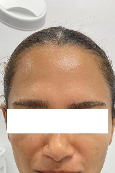 After — Neuromoduladores 2 - Antes