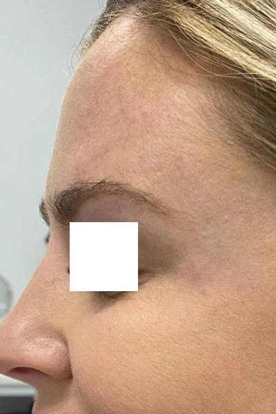After — Neuromoduladores 3 - Antes