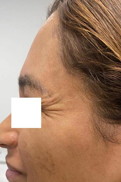 Before — Neuromoduladores 4 - Antes