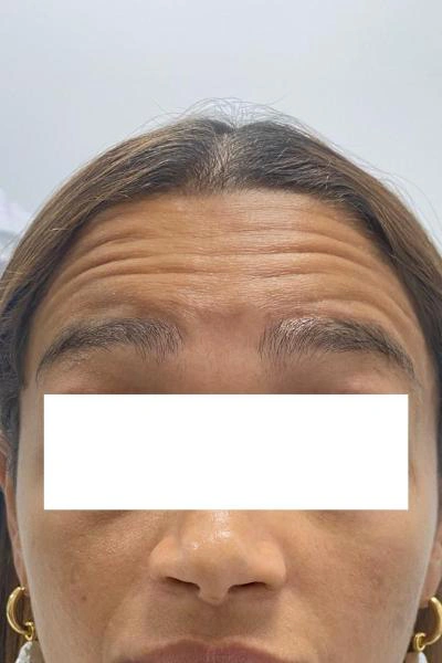 Before — Neuromoduladores 5 - Antes