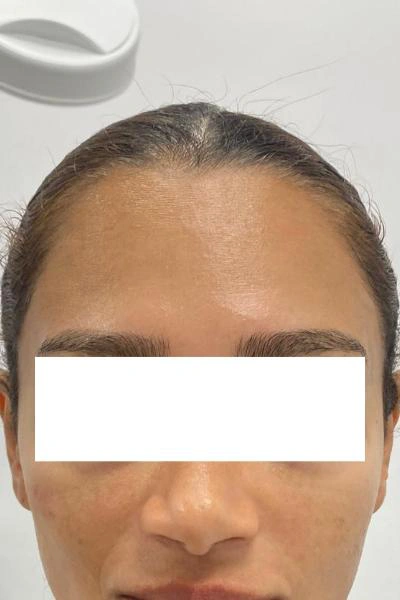 After — Neuromoduladores 5 - Antes