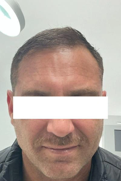After — Neuromoduladores 6 - Antes