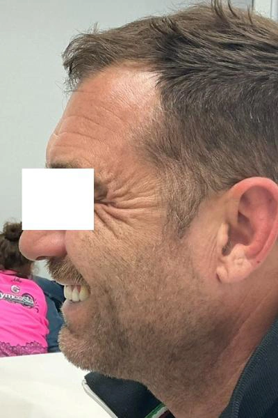 Before — Neuromoduladores 7 - Antes