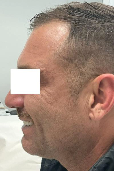 After — Neuromoduladores 7 - Antes