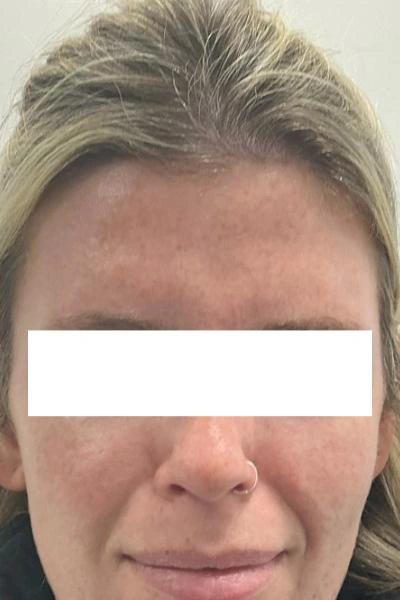 After — Neuromoduladores 8 - Antes