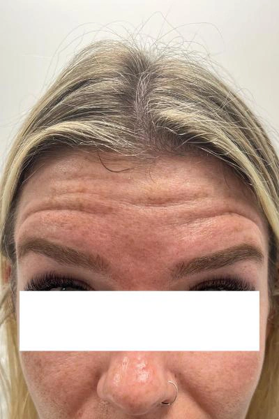 Before — Neuromoduladores 9 - Antes