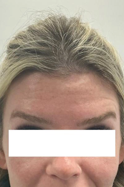After — Neuromoduladores 9 - Antes