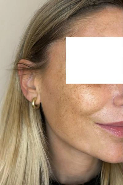 Before — Peelings quimicos 2 - Antes