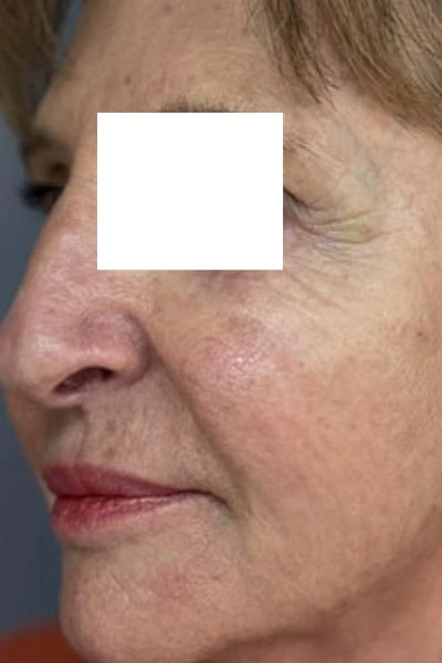 Before — Polinucleotidos 1 - Antes
