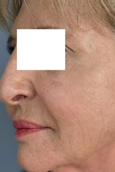 After — Polinucleotidos 1 - Antes
