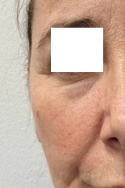 Before — Polinucleotidos 2 - Antes