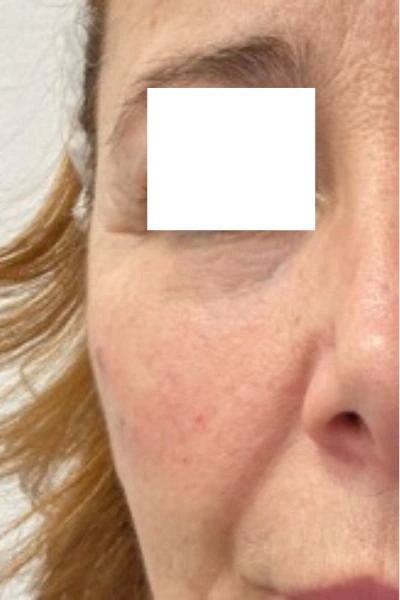 After — Polinucleotidos 2 - Antes