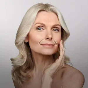 Procedure — Nasolabial folds and marionette lines