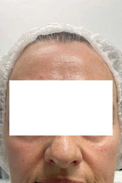 Antes — Rellenos faciales 3 - Antes