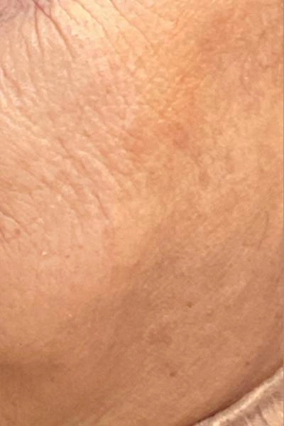 Después — Skinbooster 2 - Antes