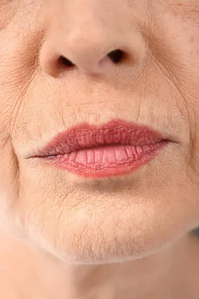 Before — arrugas peribucales 1 antes
