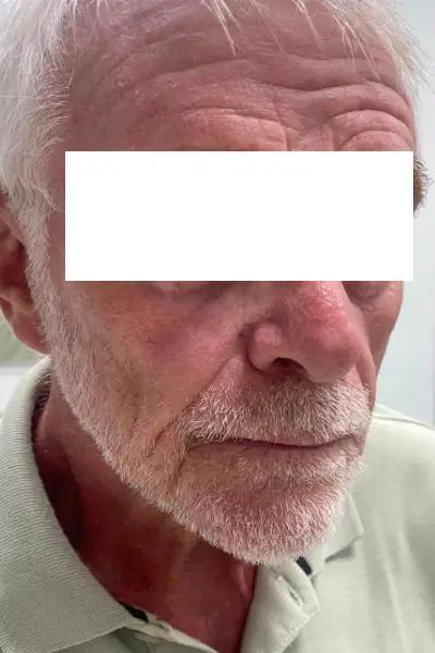 Antes — estimuladores de colageno 1 antes