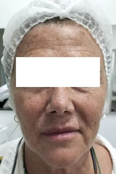 Antes — estimuladores de colageno 5 antes