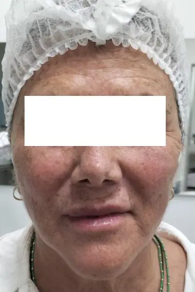 Después — estimuladores de colageno 5 antes