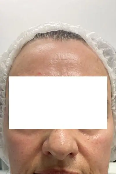 Antes — estimuladores de colageno 8 antes