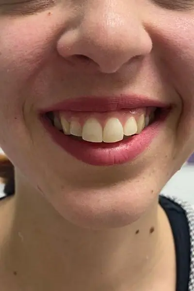 Antes — sonrisa gingival 1 antes