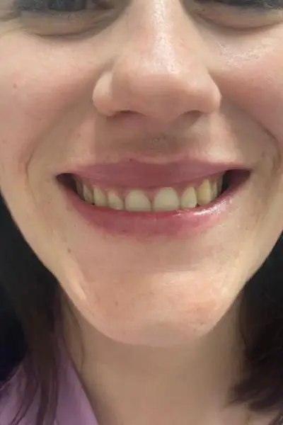Después — sonrisa gingival 2 antes