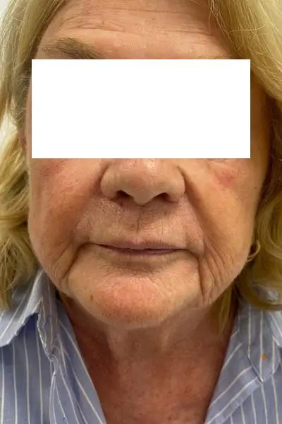 Before — surco nasogeniano 1 antes