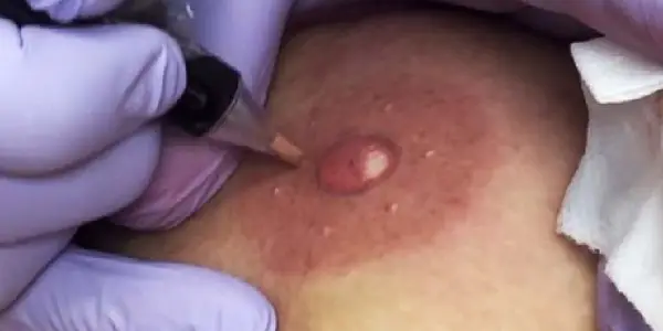 Areolas