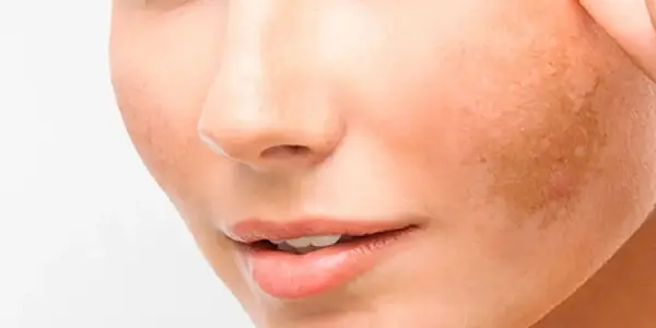 Pigmentation