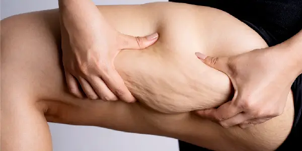 Lipedema