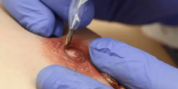 Micropigmentación de areolas