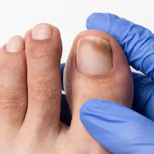 Evaluación inicial — Onicomicosis
