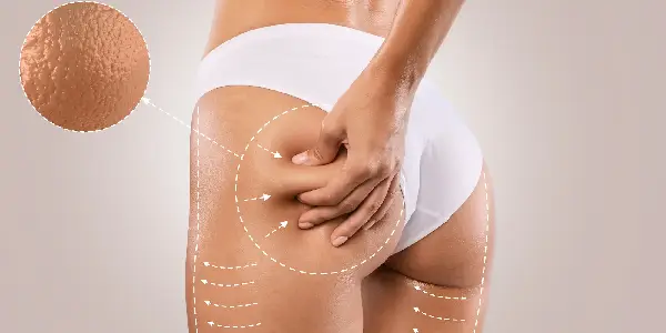 Celulitis